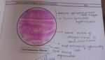 Oral submucous fibrosis - oral Pathology notes with histology diagram - Image 2