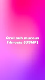 Oral submucous fibrosis - oral Pathology notes with histology diagram